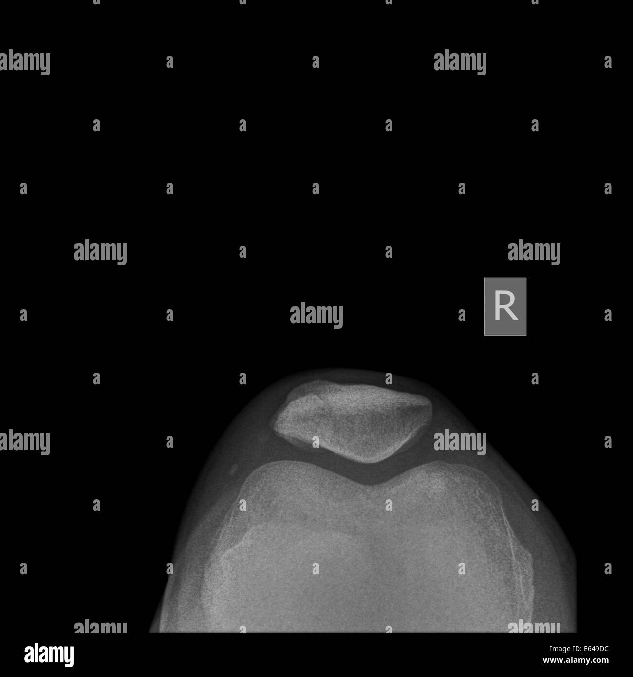 Frattura della rotula e del ginocchio raggi x di 27 anno vecchio paziente di sesso maschile vista superiore Foto Stock
