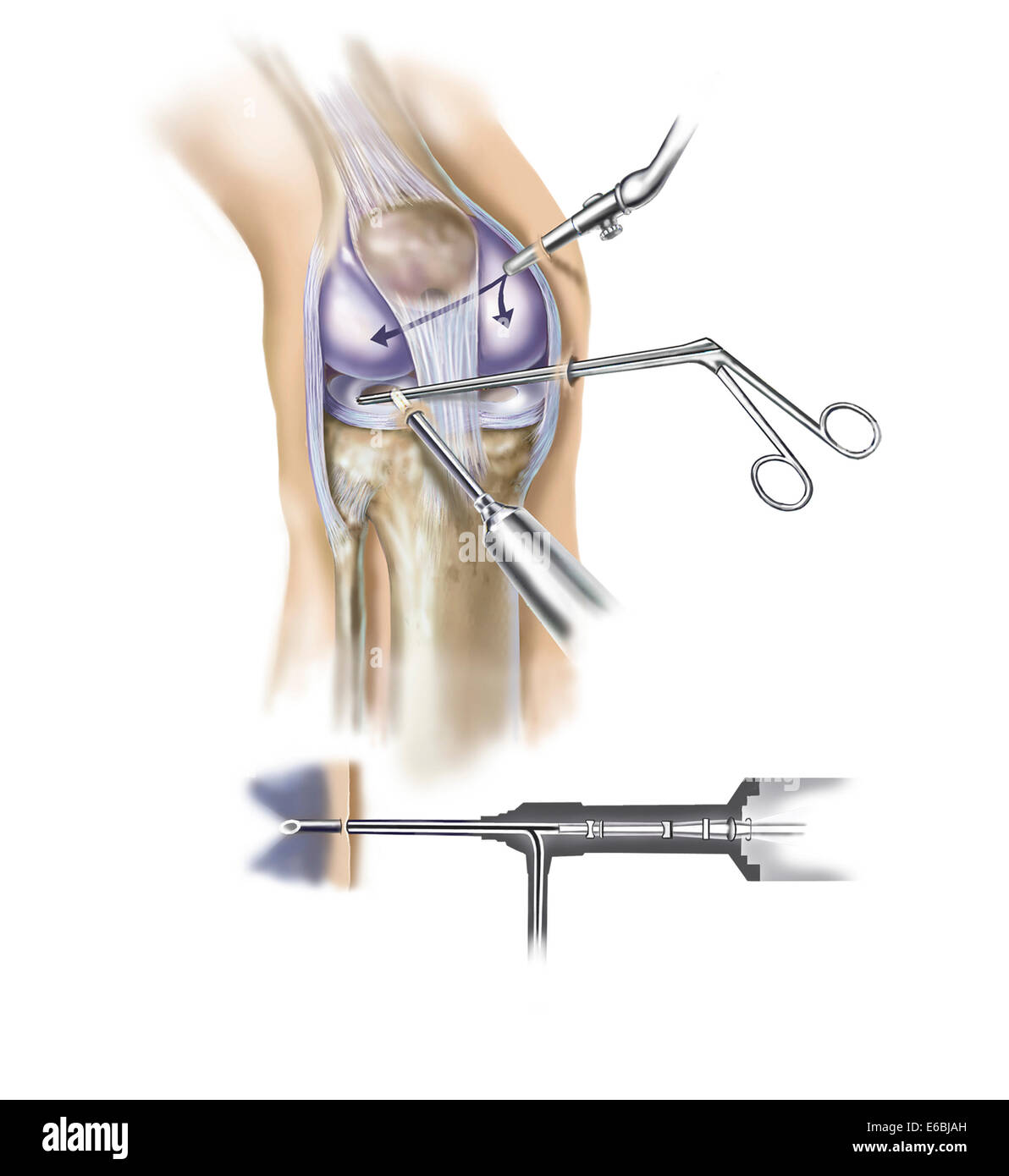 Dettaglio del ginocchio umano che mostra l'inserimento di strumenti artroscopica. Foto Stock
