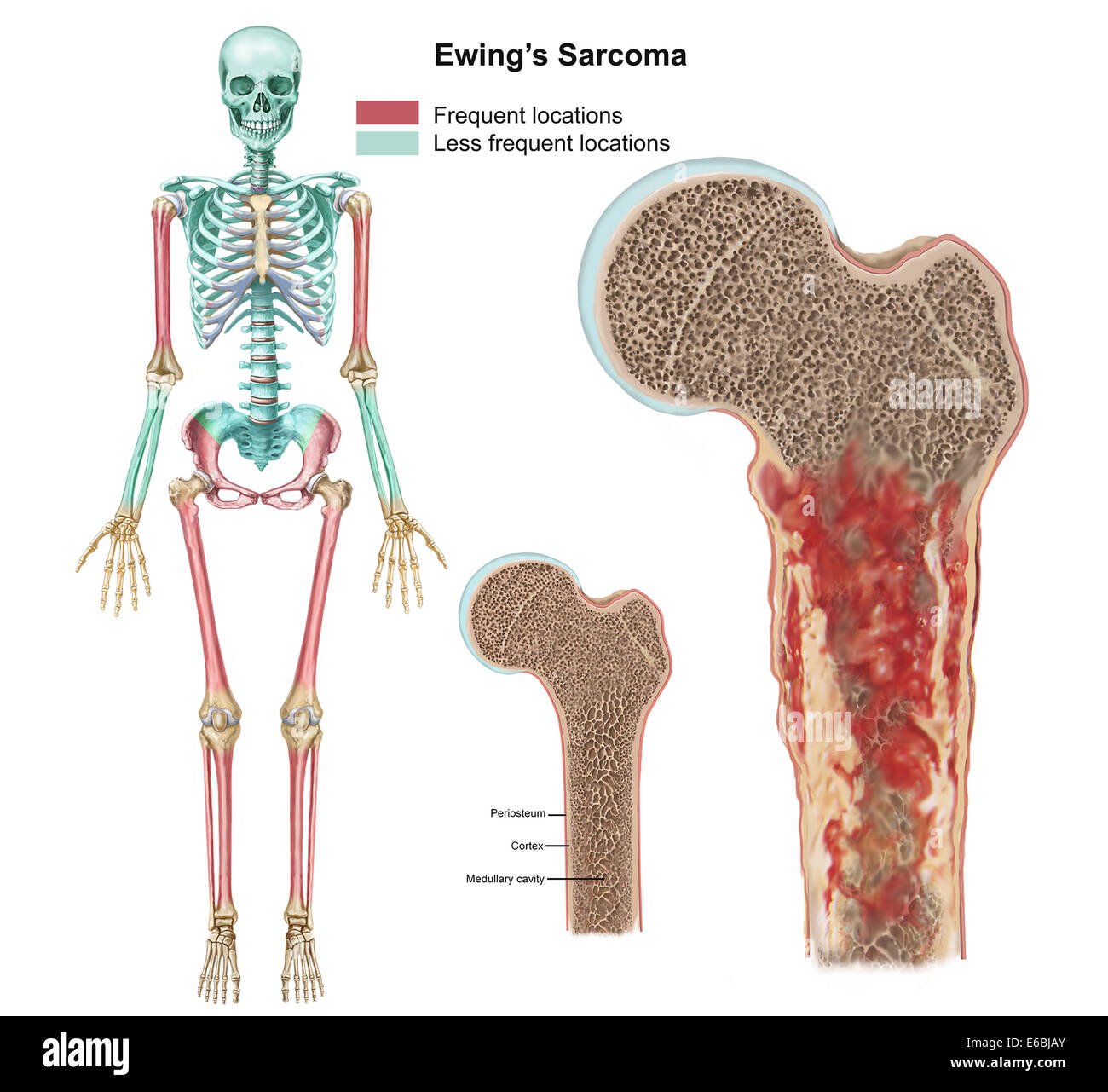Sarcoma Ewings posizioni su scheletro e dettaglio di tumore sulla testa del femore. Foto Stock