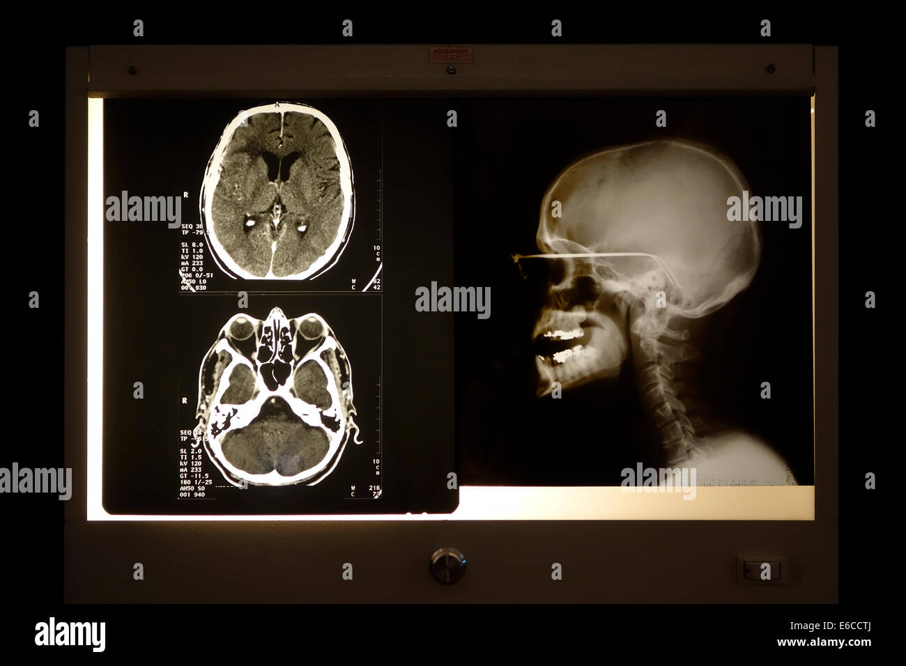 Immagine a raggi X del cranio e cranio tomografia computerizzata visti di Scansione sulla casella di luce Foto Stock