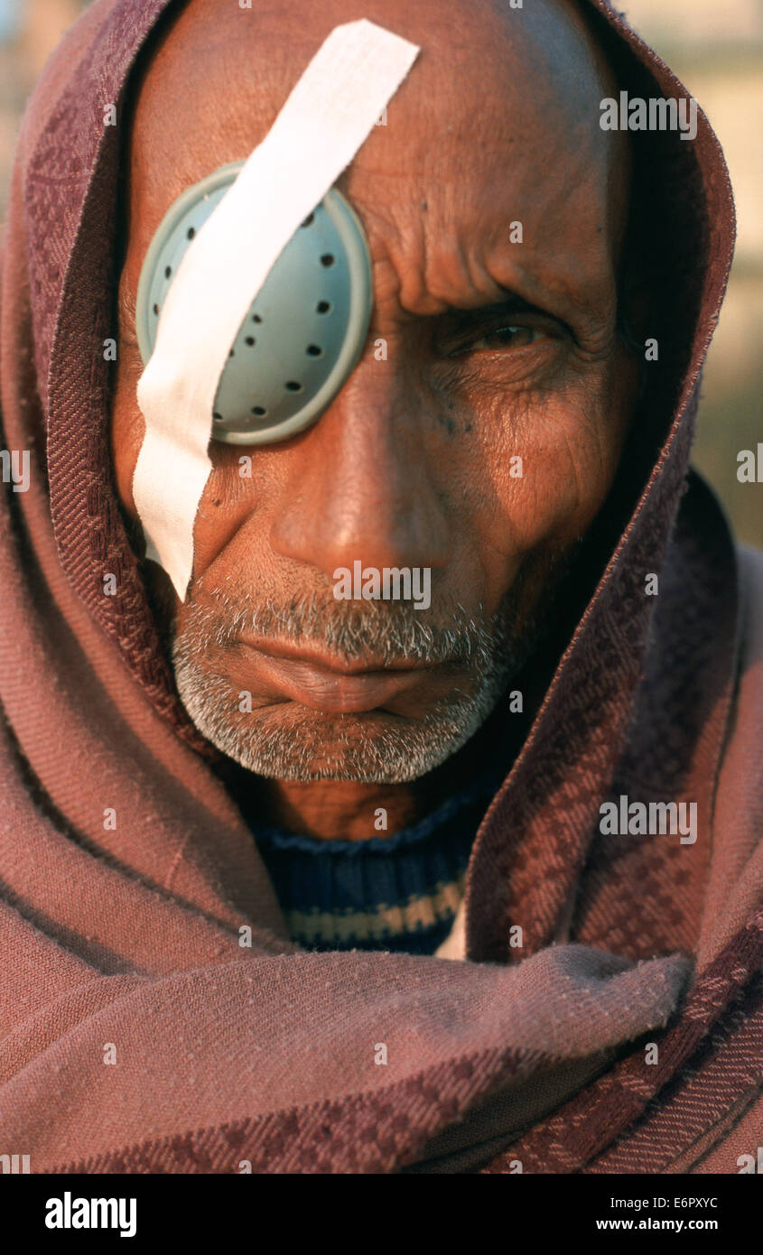 Uomo che ha avuto chirurgia della cataratta durante un collettivo di camp indotto dai chirurghi che operano persone povere per libero ( Nepal) Foto Stock