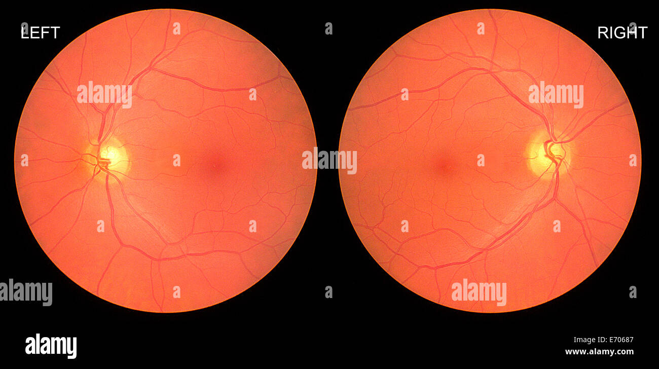 Immagine del fundus occhio sano età maschio 58. mostra la retina, vene Foto Stock