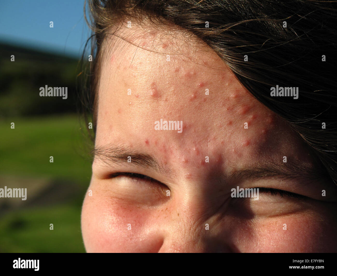 Giovane ragazza adolescente con macchie acne Foto Stock