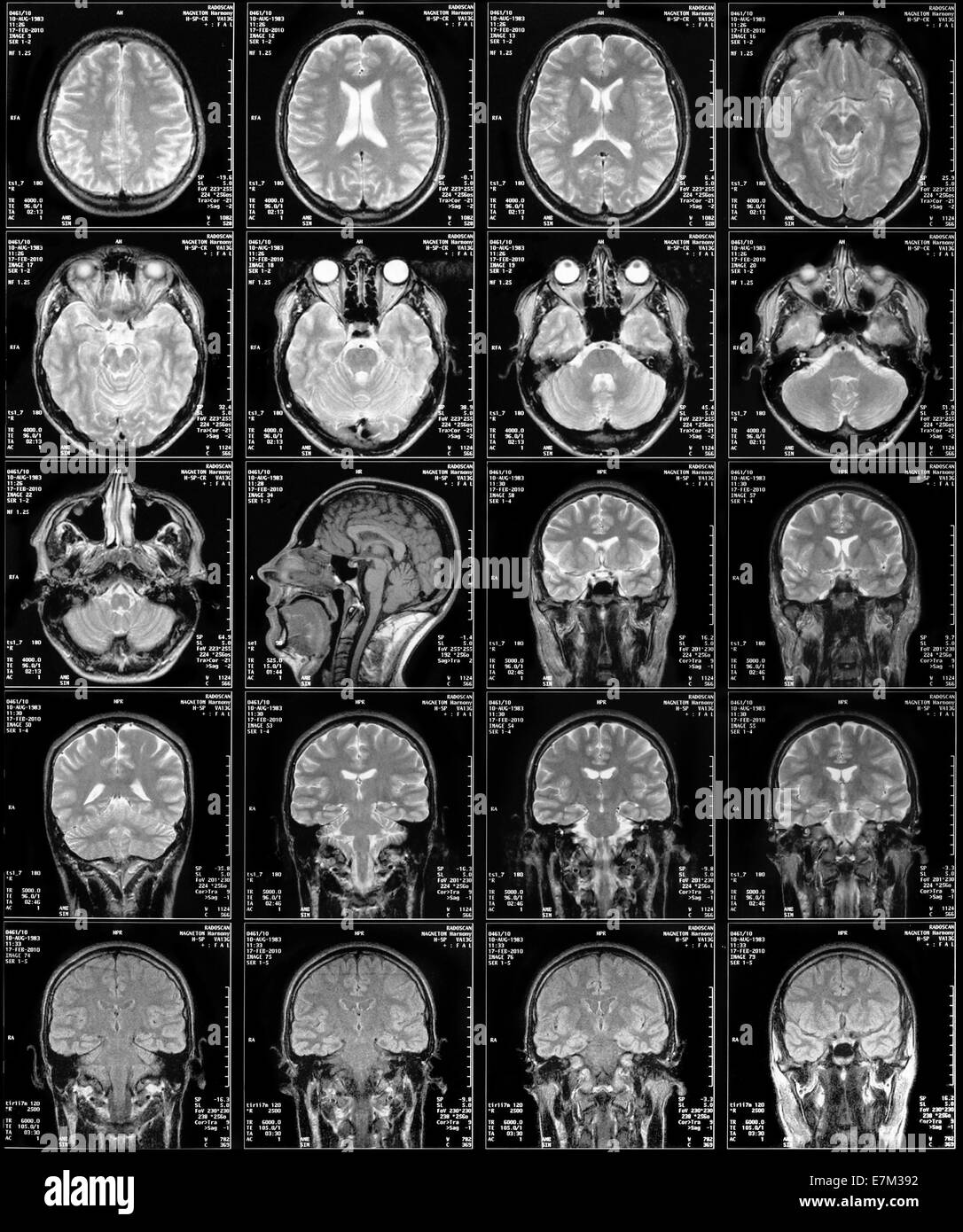Il rilevamento di immagini in risonanza magnetica nucleare, l'immagine della testa in piani diversi Foto Stock