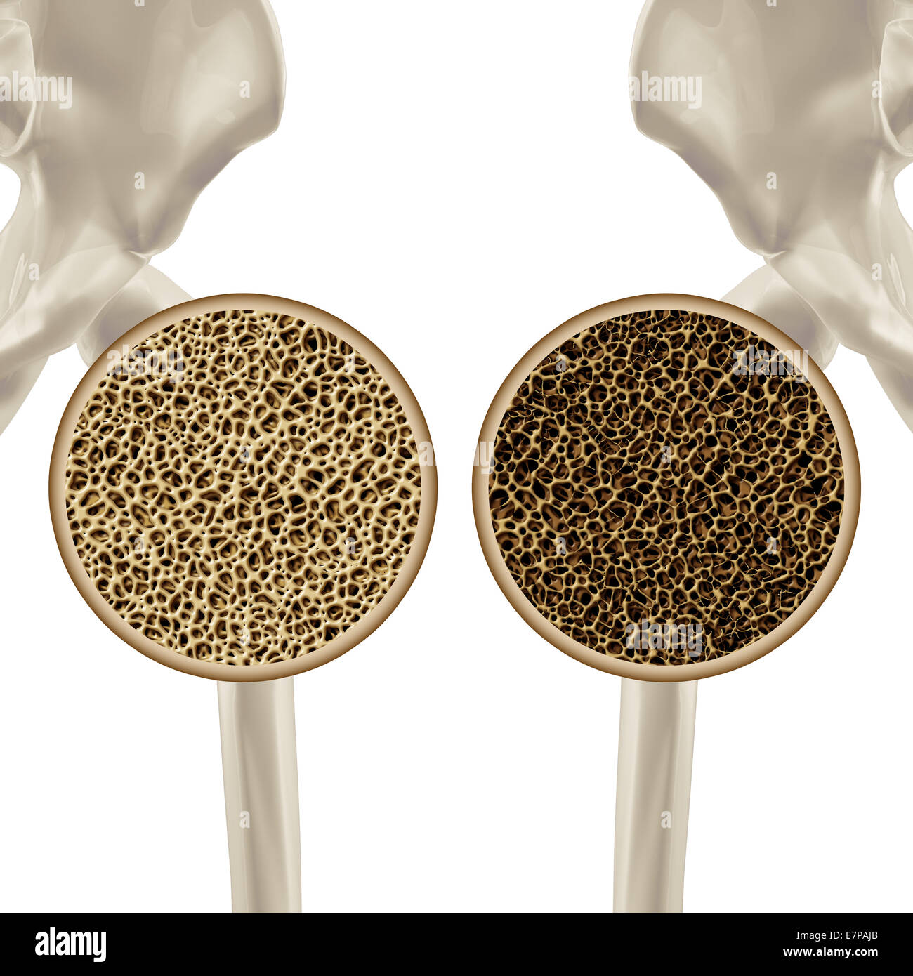L'Osteoporosi Illustrazione medica health care concetto che mostra la scheletrico umano dell'anca come una chiusura di un sano e malsano poroso schema di osso. Foto Stock
