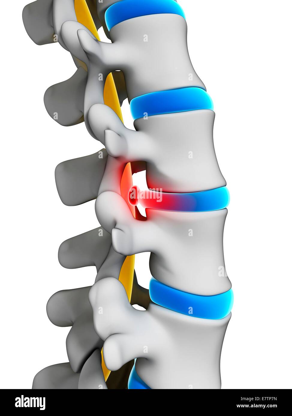 Colonna vertebrale umana ernia del disco (scivolato disco), computer grafica. Foto Stock