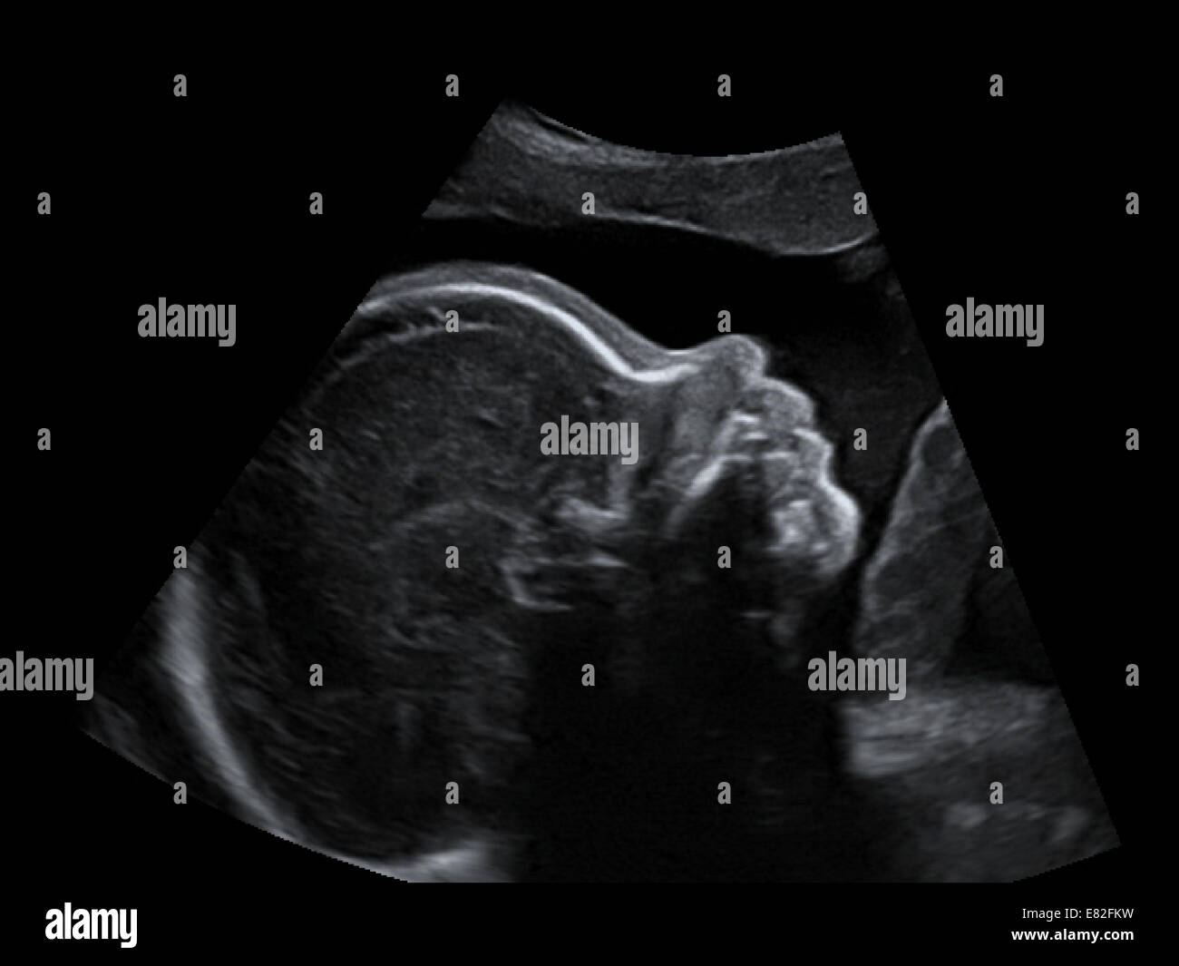 Scansione ad ultrasuoni di un feto, età gestazionale : 26 settimane e 4 giorni. Foto Stock