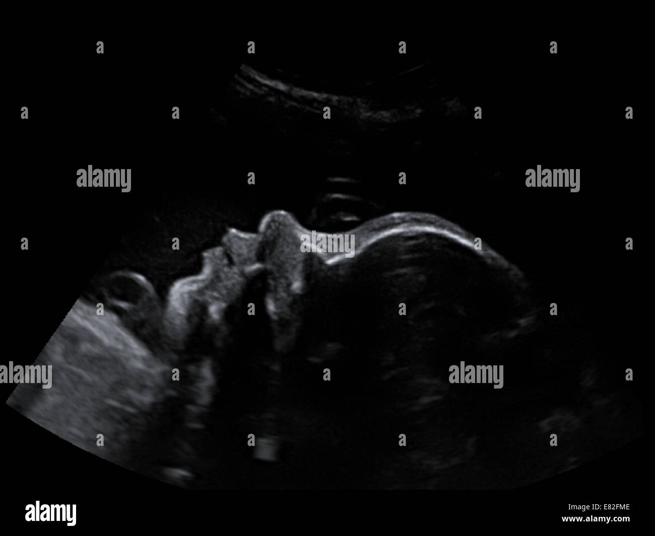 Scansione ad ultrasuoni di un feto, età gestazionale : 32 settimane. Foto Stock