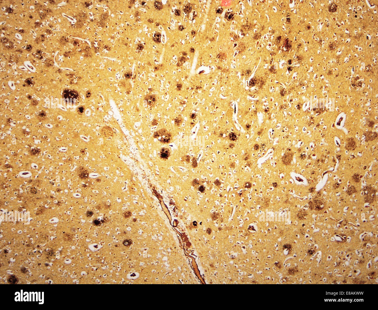 Il morbo di Alzheimer, placche neuritiche Foto Stock