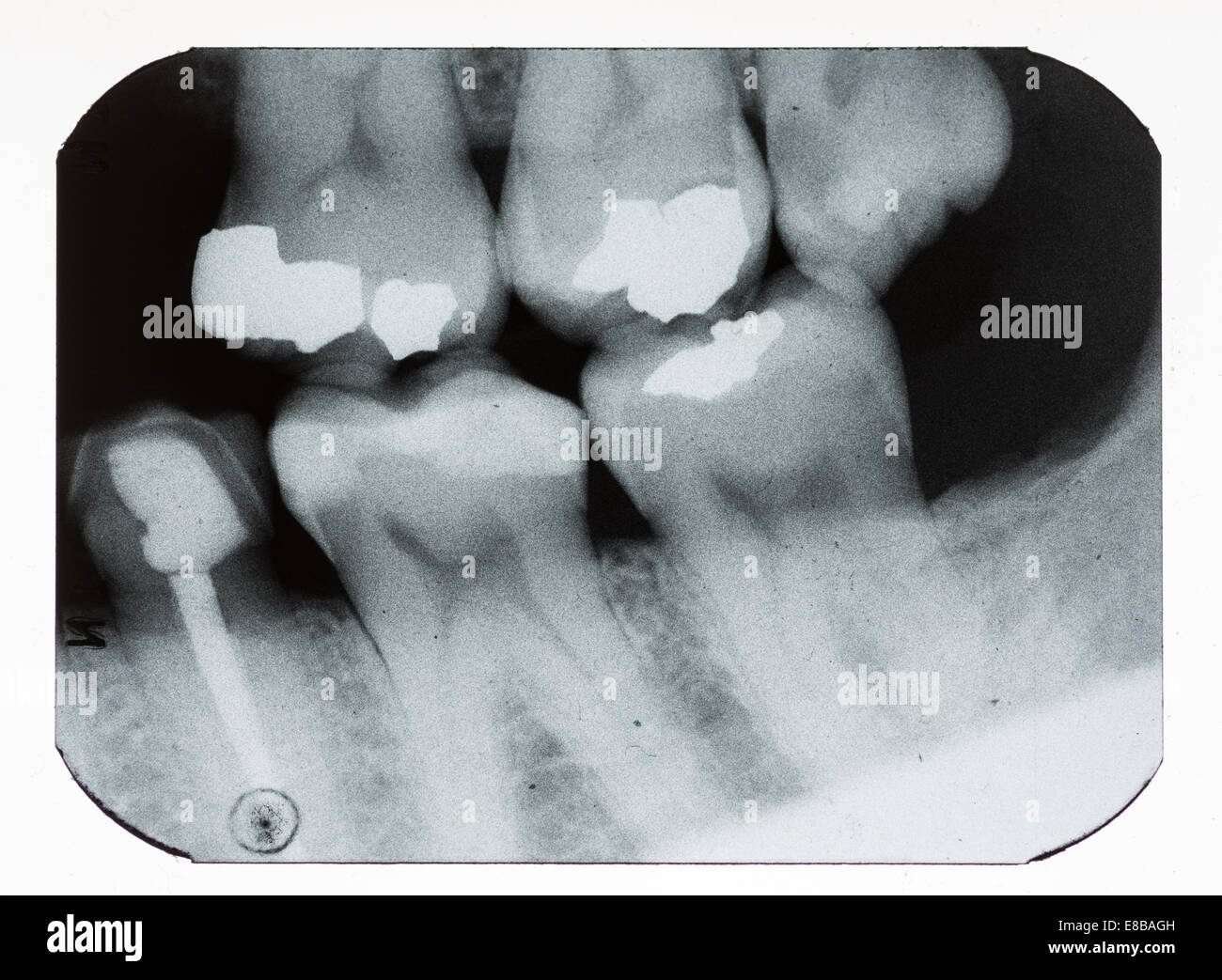 Dental xray mostra otturazioni e denti mancanti Foto Stock