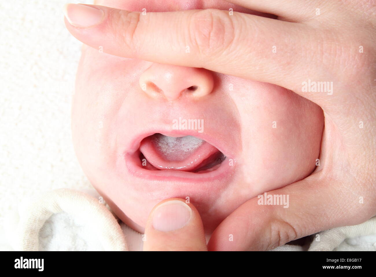 La candidosi orale di un neonato Foto Stock