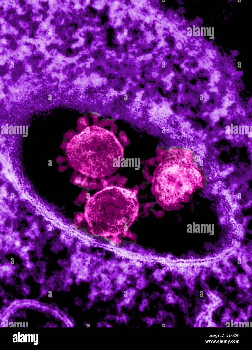 Colorizzato micrografia elettronica a trasmissione che mostra particelle del Medio Oriente la sindrome respiratoria Coronavirus che è emersa in Foto Stock