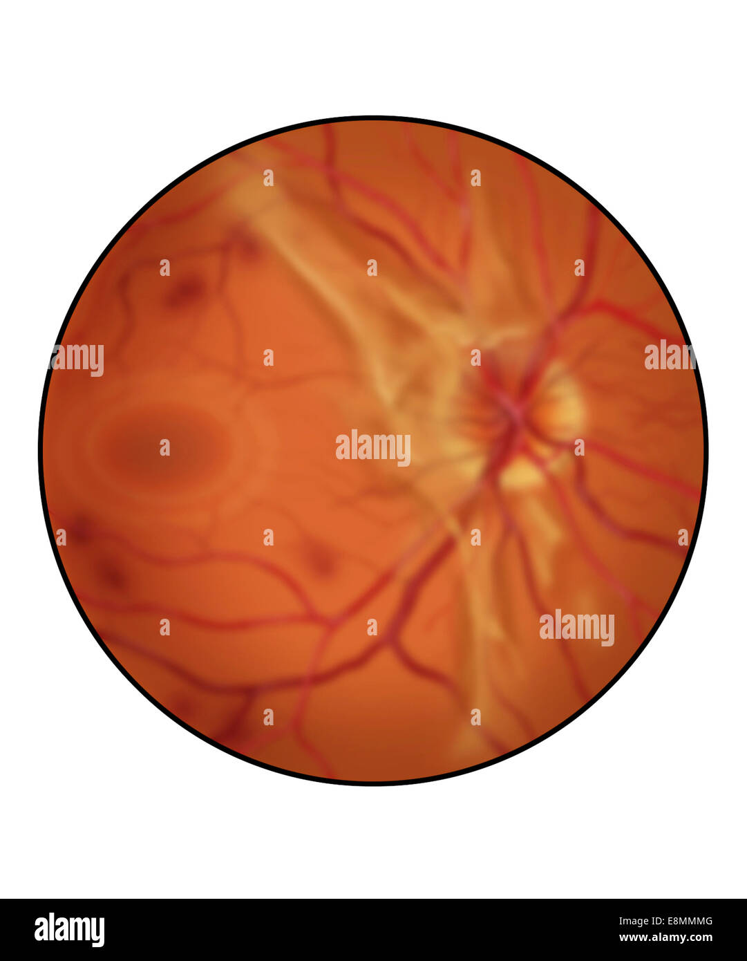 Retina con avanzata retinopatia diabetica, mostranti accresciuto il tessuto cicatriziale, emorragia e diffondere vetroso di sangue (appea sfocata Foto Stock