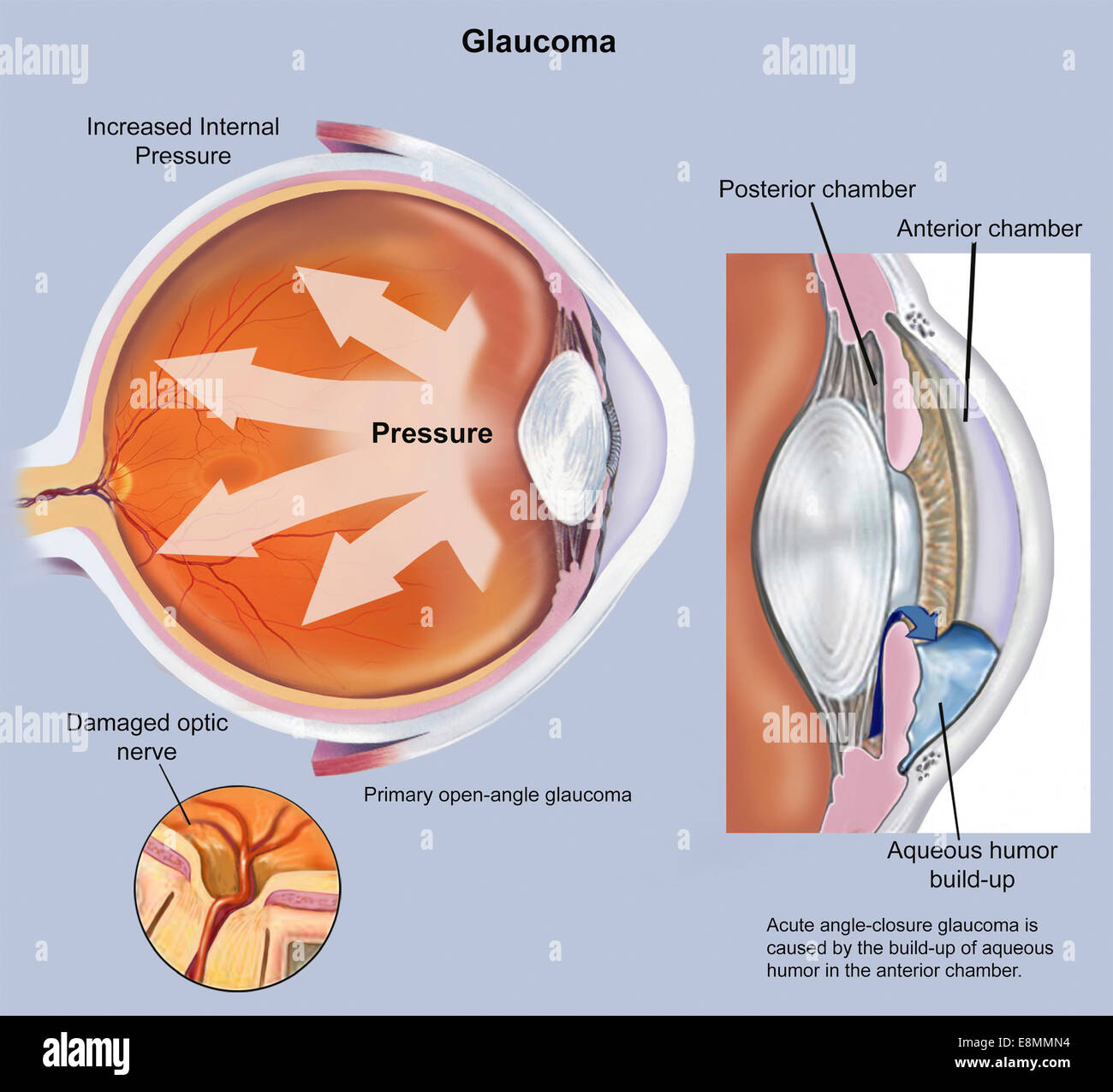 La retina dell'occhio con il glaucoma. Foto Stock