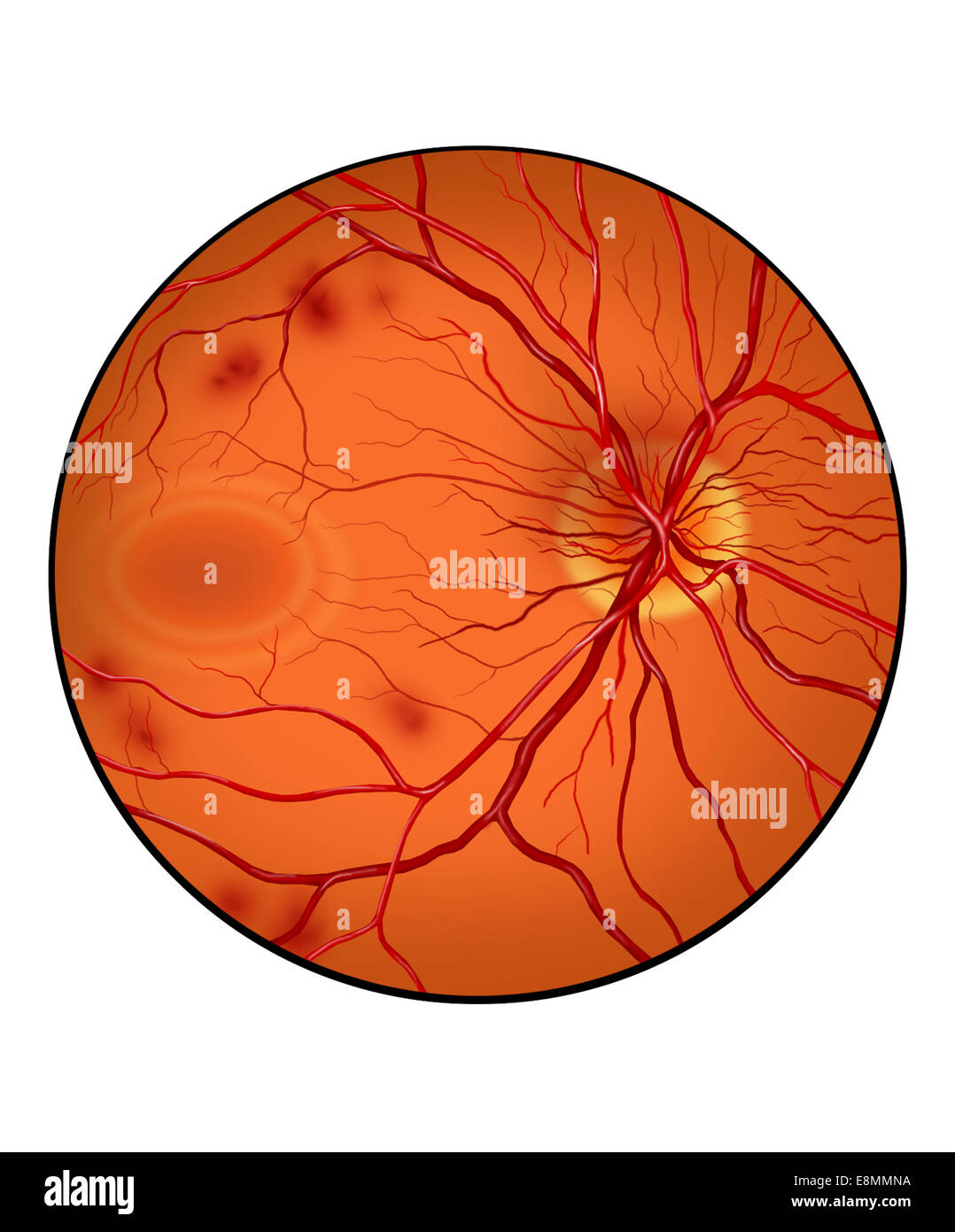 La retina con la neovascolarizzazione che mostra emorragie retiniche. Foto Stock