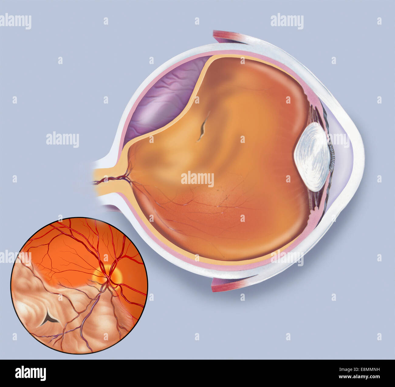 Schema di un distacco della retina. Foto Stock