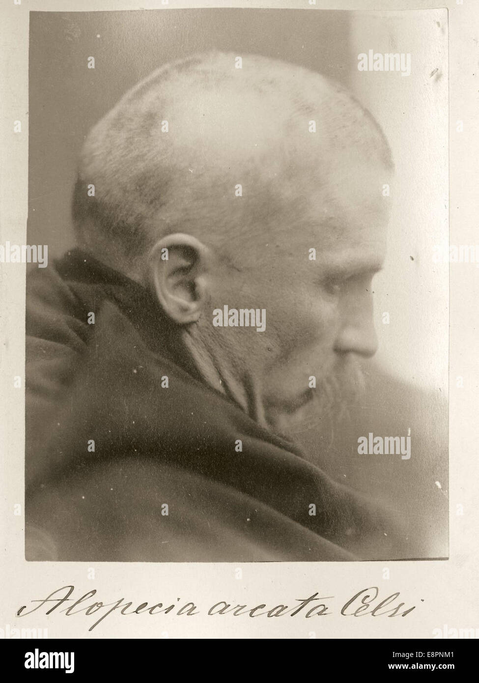 Questa fotografia mostra un uomo adulto con alopecia areata, una condizione che porta alla calvizie. L'immagine fa parte di una collezione clinica del XIX secolo, che documenta le condizioni mediche dell'epoca. Foto Stock