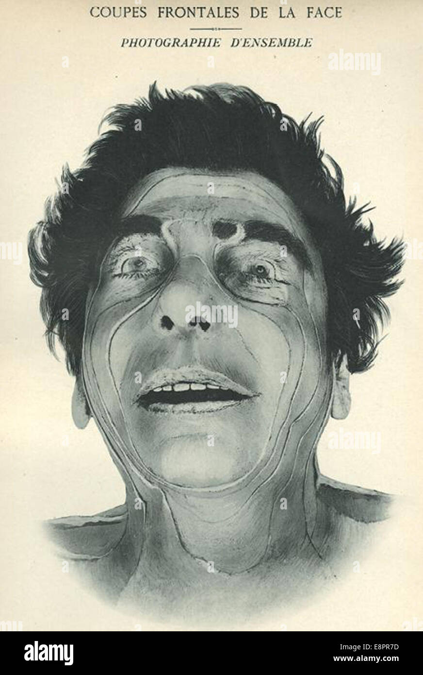 Questa fotografia presenta una vista frontale di un volto, probabilmente da uno studio anatomico o da una ricerca medica, fornendo una documentazione visiva dettagliata delle caratteristiche facciali. Foto Stock