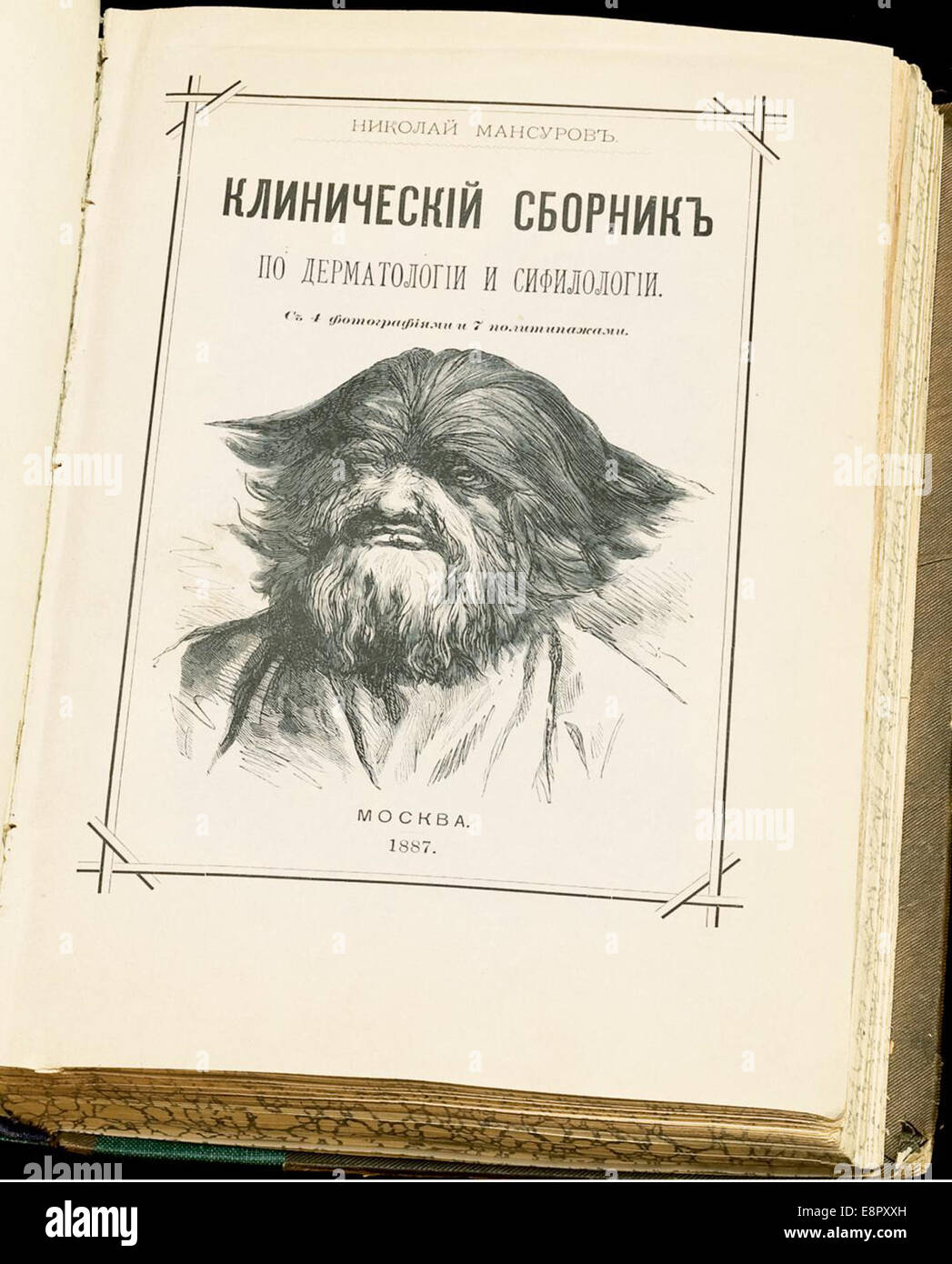 Un'illustrazione tratta dalla collezione clinica di Mansurov, raffigurante un "uomo peloso", ispirata al suo incontro con un caso di ipertricosi (crescita eccessiva dei capelli). L'incisione illustra questa rara condizione, pubblicata nel 1887. Foto Stock