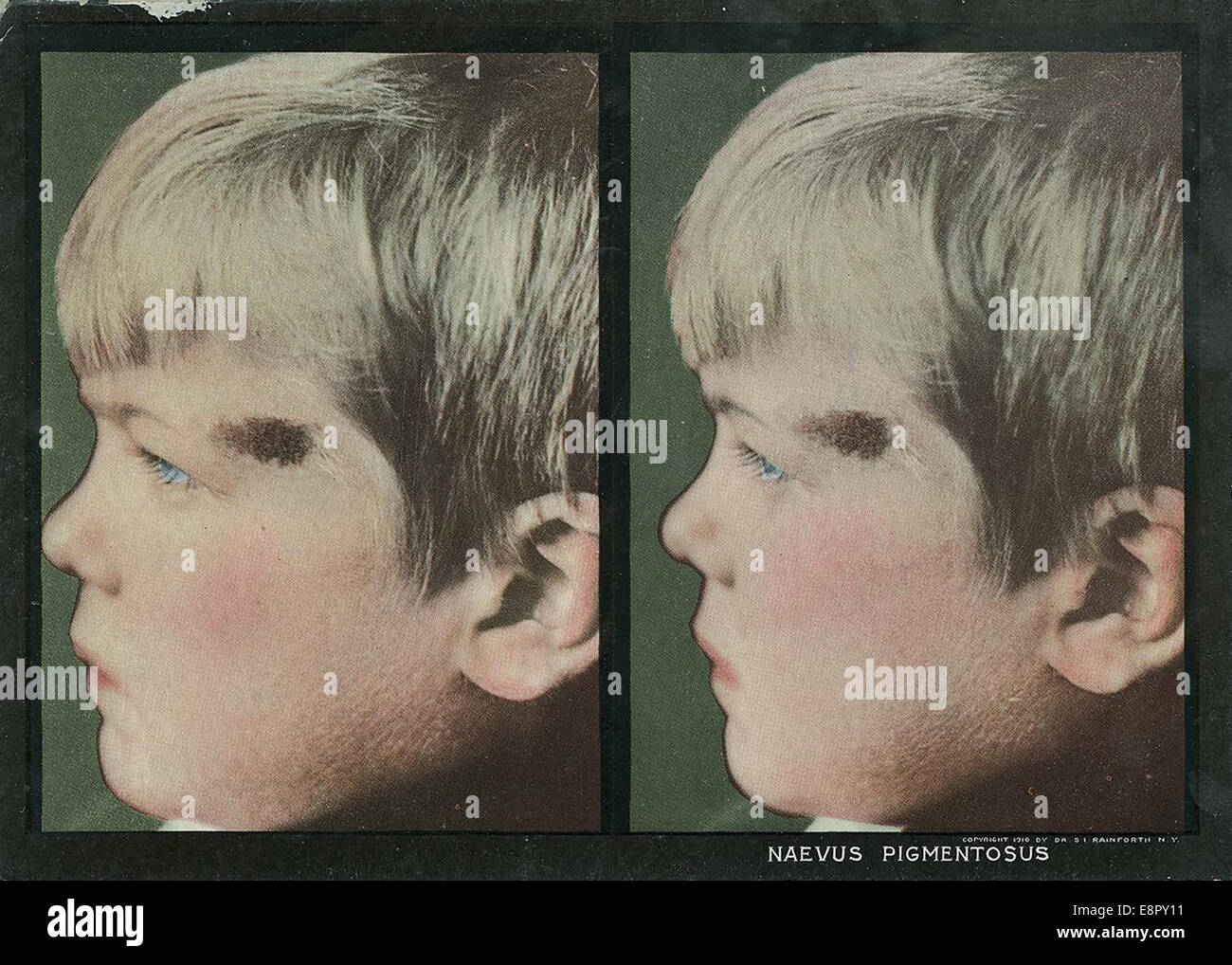 Un'immagine stereoscopica dalla fine del XIX secolo all'inizio del XX che mostra un ragazzo con una talpa pigmentaria vicino all'occhio sinistro, presa come parte di uno studio dermatologico di Selden Irwin Rainforth. Questa immagine faceva parte di una collezione di stereografi clinici per la pelle. Foto Stock