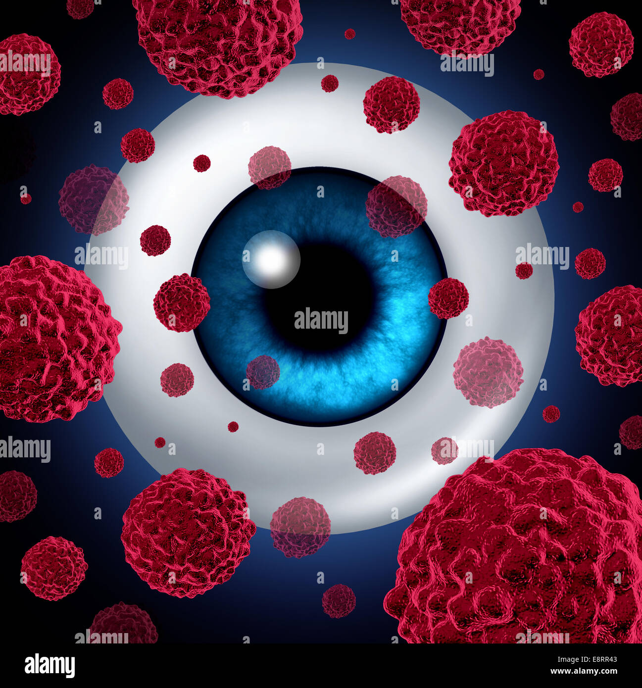 Occhio concetto di cancro o tumori intraoculari simbolo come un bulbo oculare umana con cellule cancerose diffondendo come un medico e sanitario Foto Stock