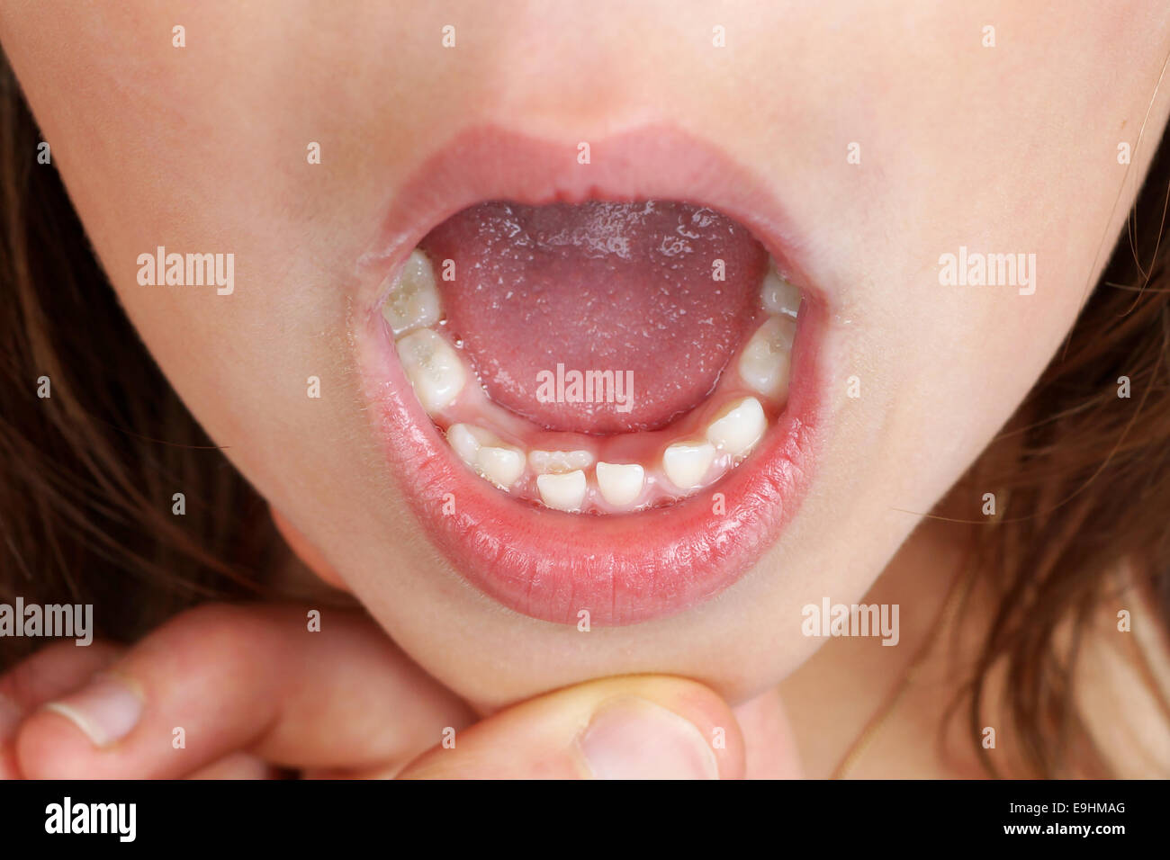 Il capretto con dente permanente, inferiore incisivo, crescente e spingendo il bambino fuori del dente Foto Stock
