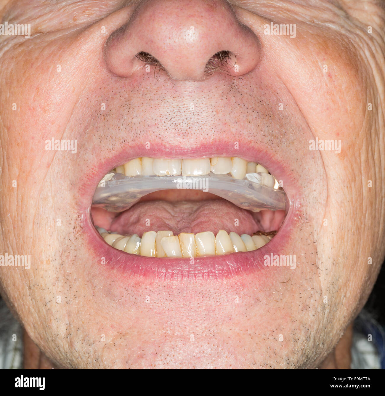 Close up della protezione dei denti in bocca senior Foto Stock