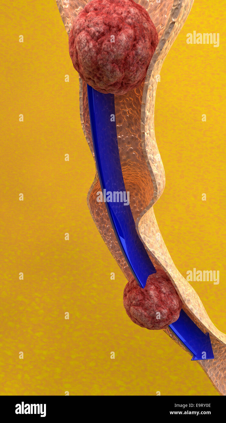 Esame dell'intestino close up su sfondo giallo Foto Stock