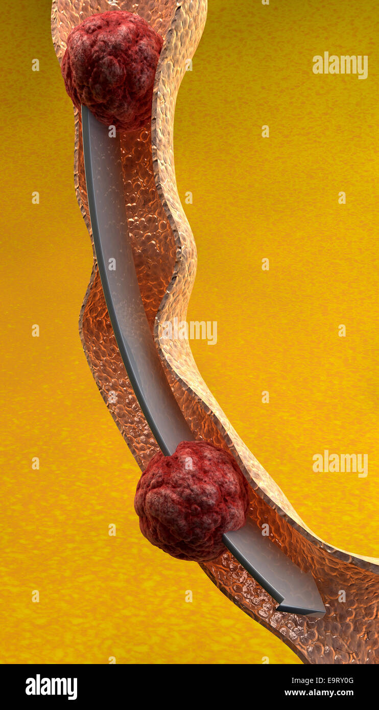 Esame dell'intestino close up su sfondo giallo Foto Stock