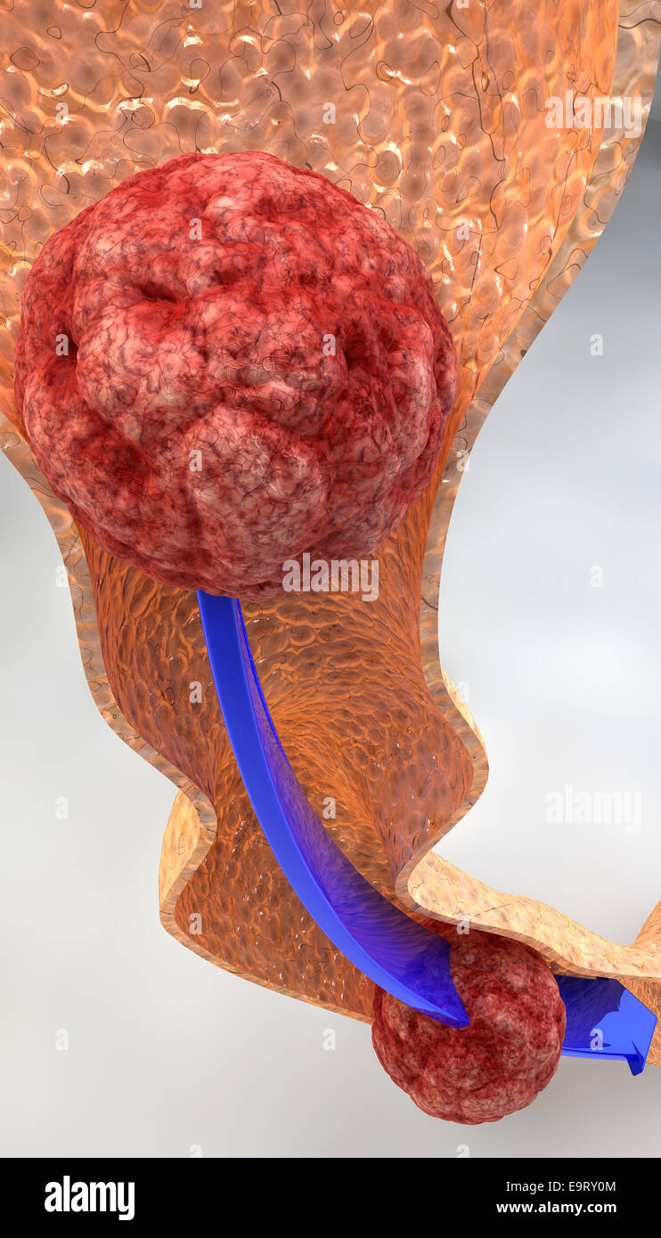 Esame dell'intestino close up Foto Stock