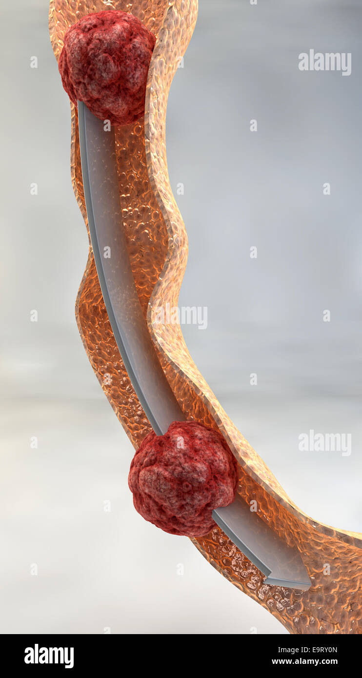 Esame dell'intestino close up su sfondo grigio Foto Stock