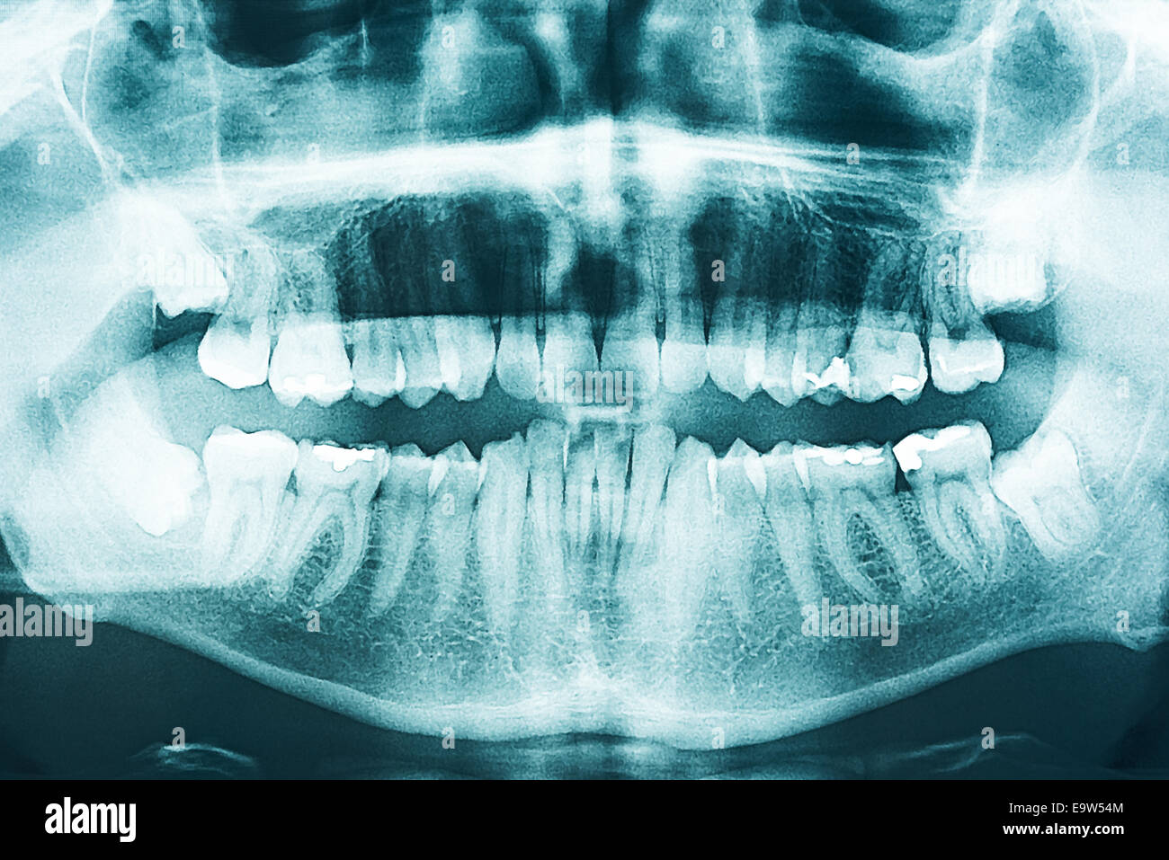 Panoramic apparecchiature odontoiatriche a raggi X e dei denti umani Foto Stock
