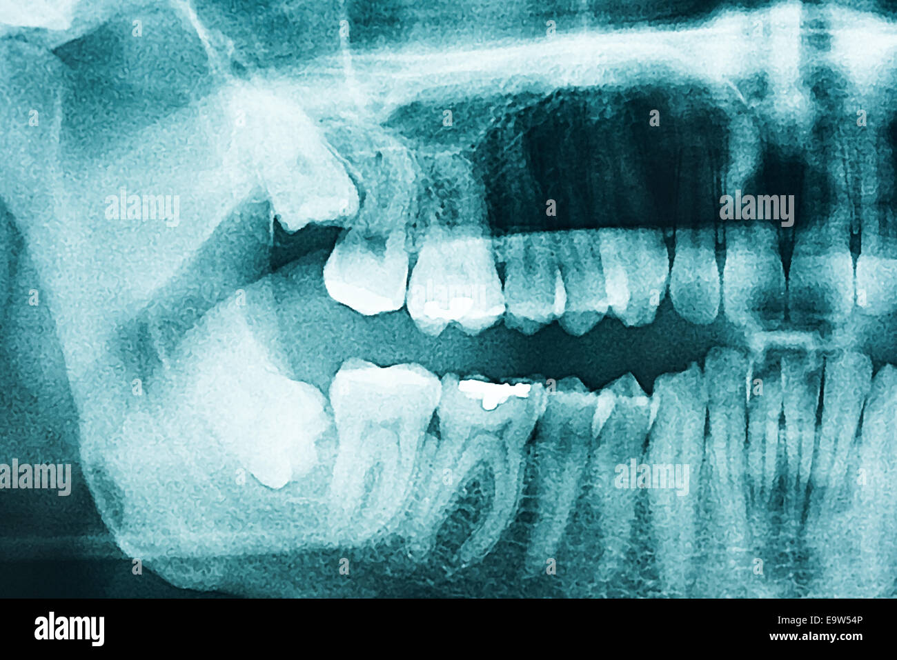 Panoramic apparecchiature odontoiatriche a raggi X e dei denti umani Foto Stock
