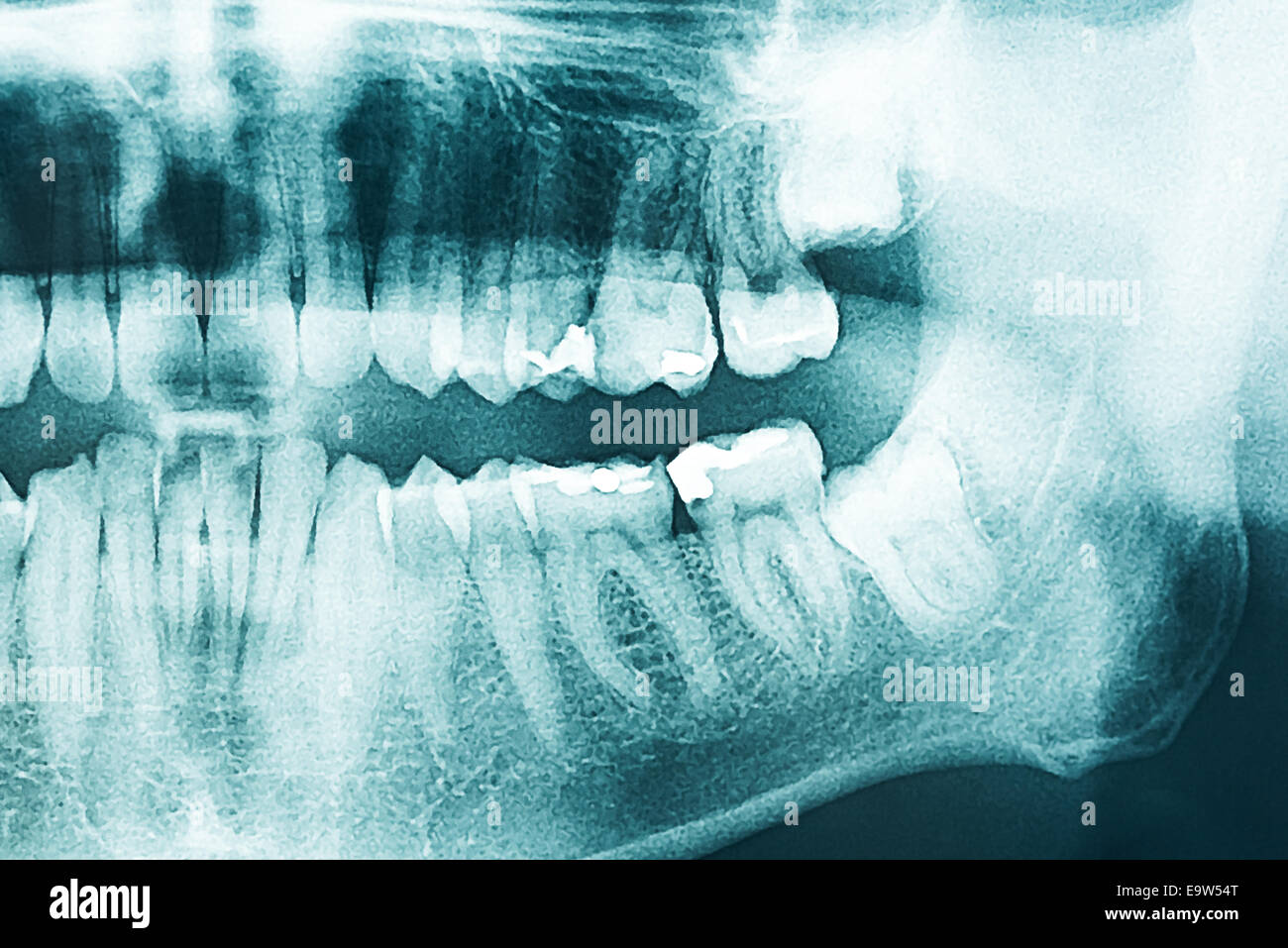 Panoramic apparecchiature odontoiatriche a raggi X e dei denti umani Foto Stock