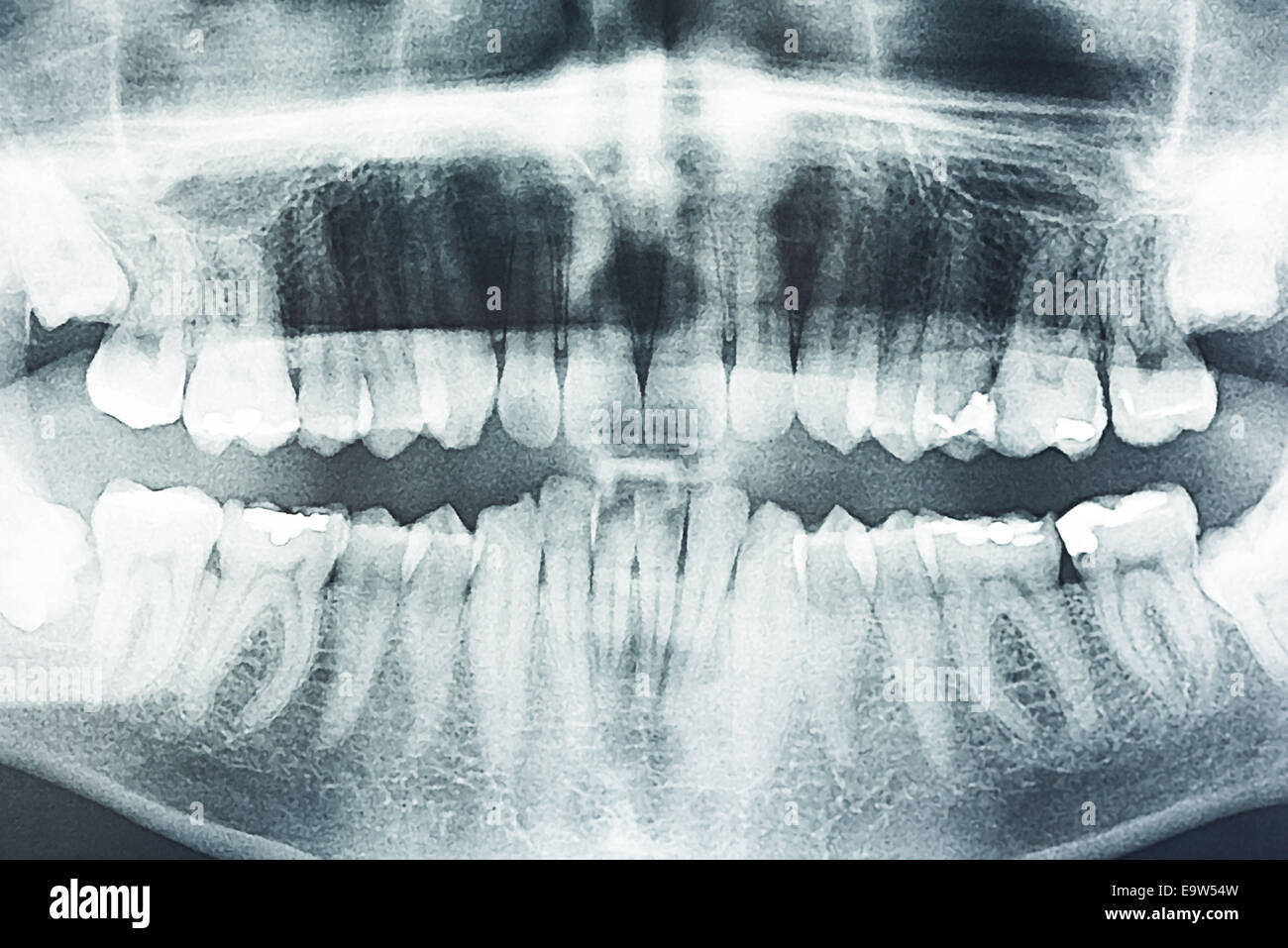 Panoramic apparecchiature odontoiatriche a raggi X e dei denti umani Foto Stock