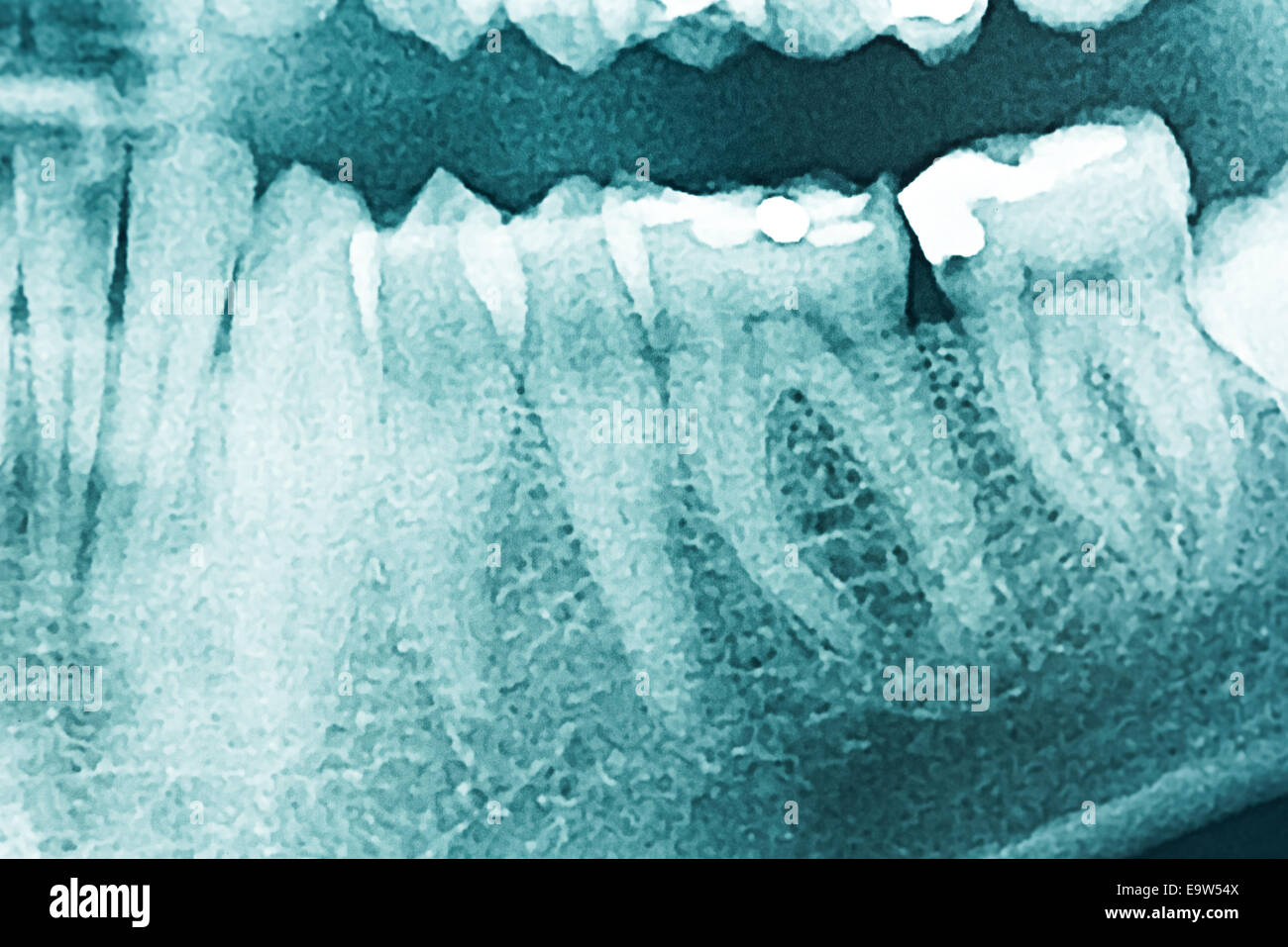 Panoramic apparecchiature odontoiatriche a raggi X e dei denti umani Foto Stock