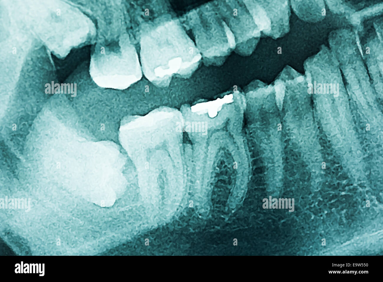Panoramic apparecchiature odontoiatriche a raggi X e dei denti umani Foto Stock