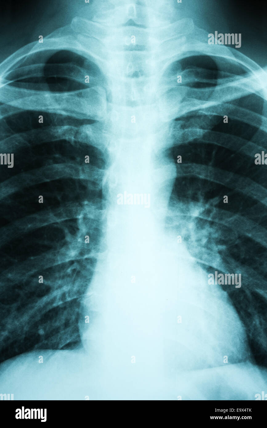 X polmonare-Ray dei polmoni del paziente Foto Stock