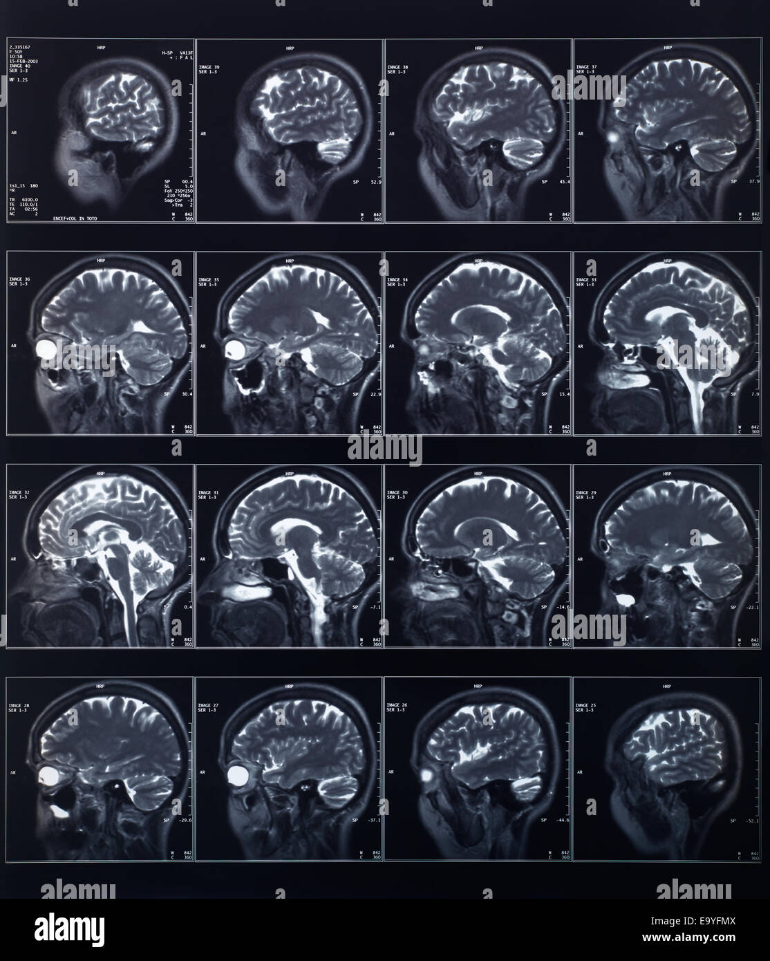 Testata a raggi X e la radiografia del cervello Foto Stock