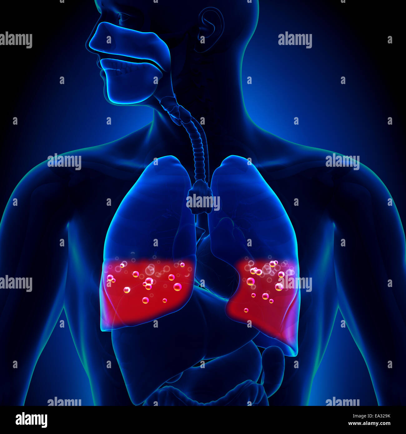 Edema polmonare - il sangue nei polmoni Foto Stock