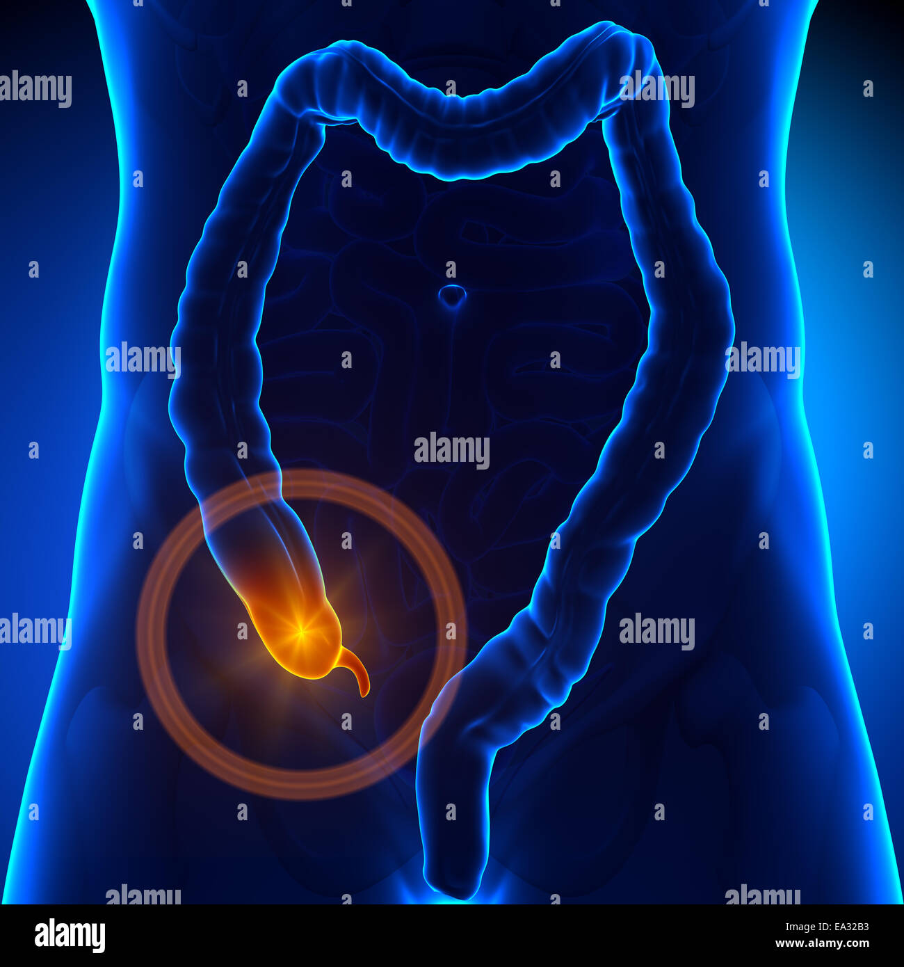 Dolore di appendice Foto Stock