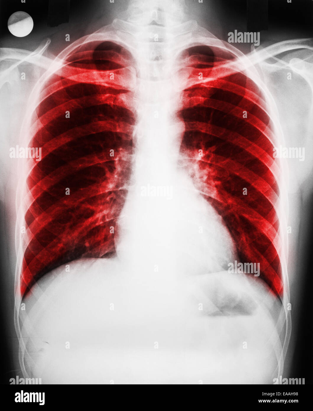 Malattia polmonare sui polmoni del paziente X-Ray Foto Stock