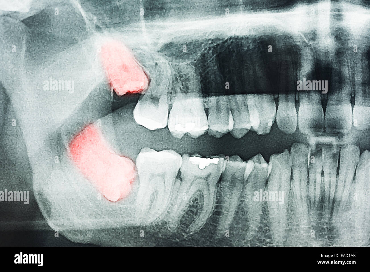 Crescente saggezza denti dolore a raggi X Foto Stock