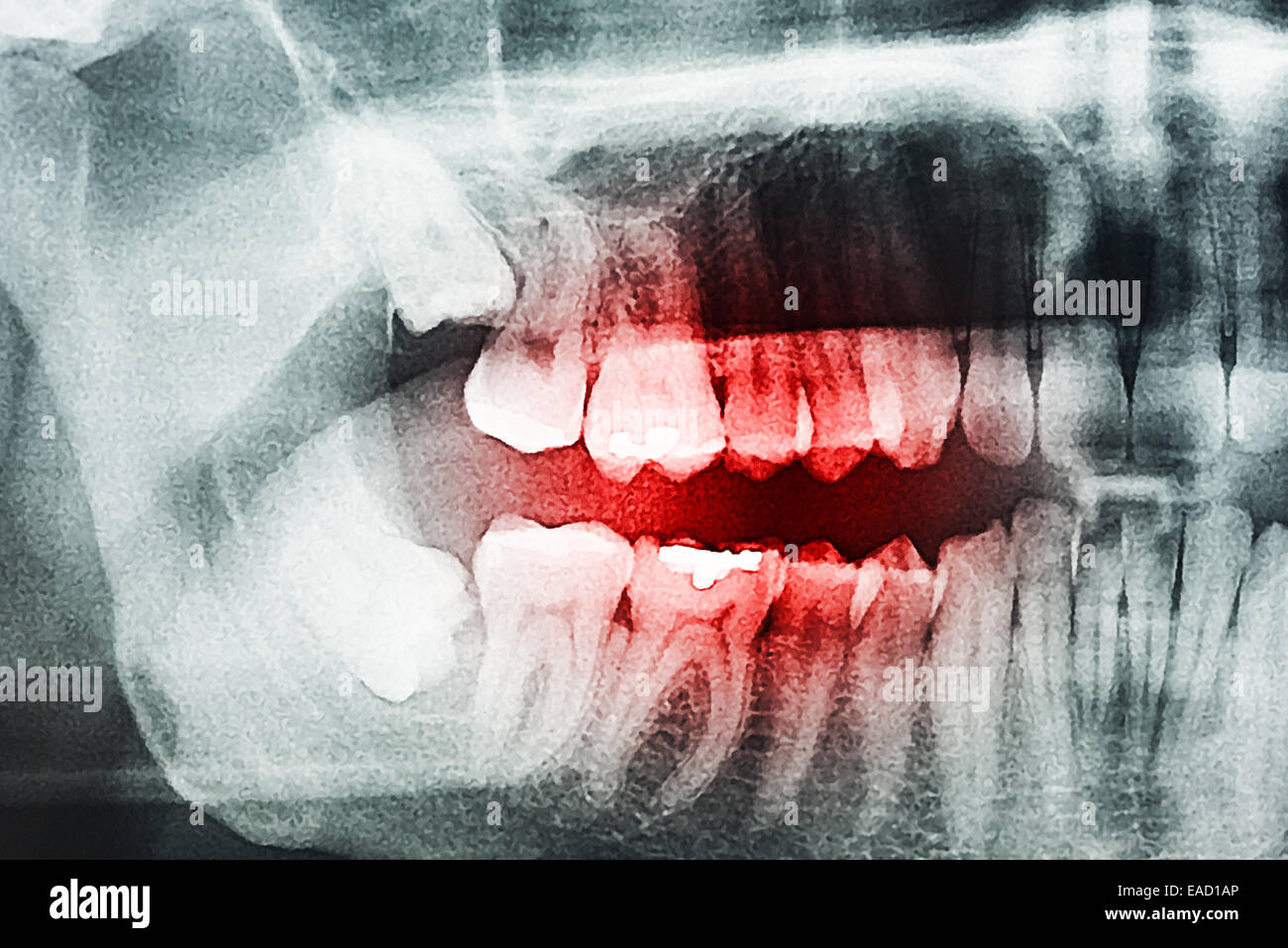 Denti cariati dolore a raggi X Foto Stock