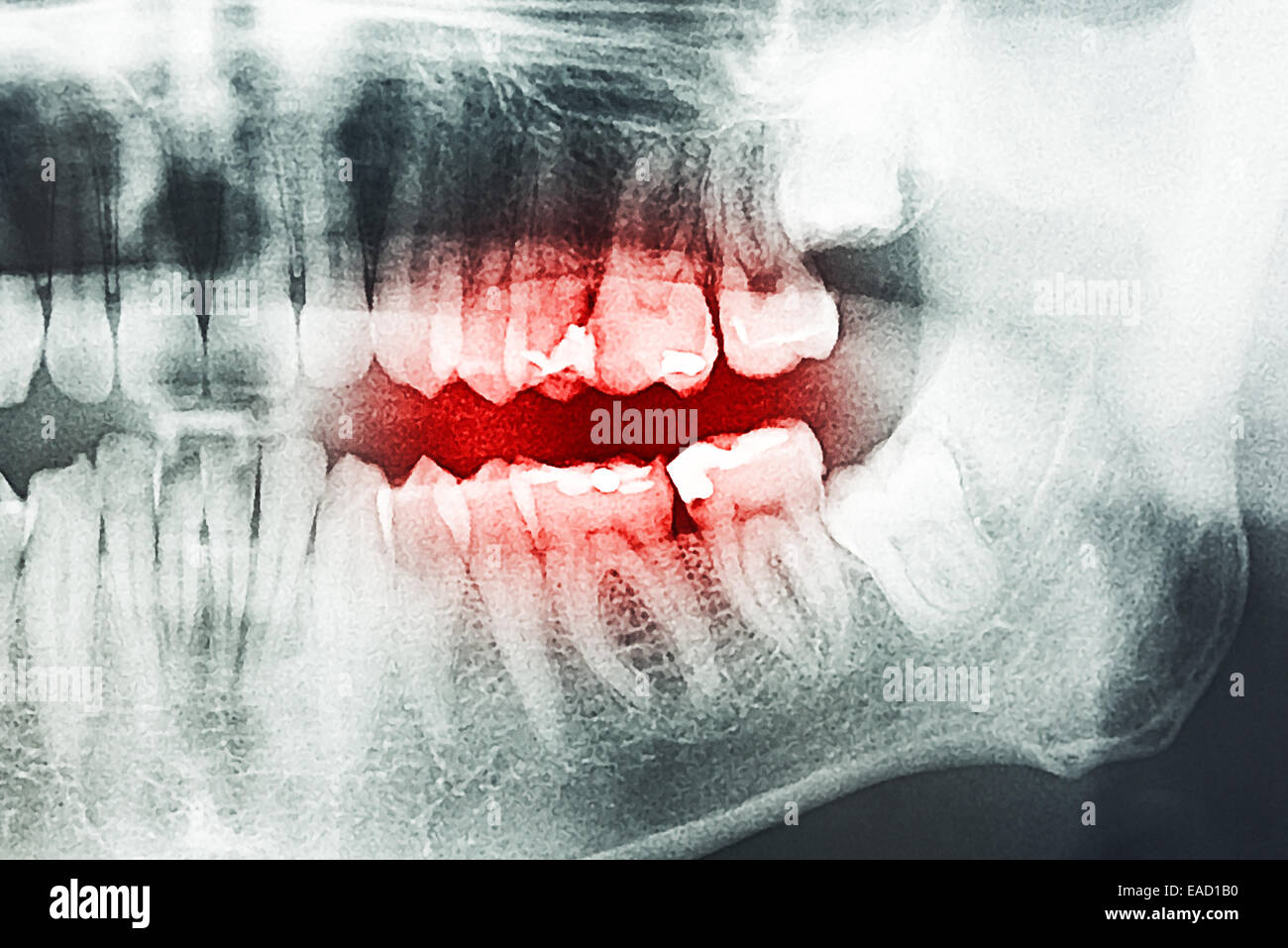 Denti cariati dolore a raggi X Foto Stock