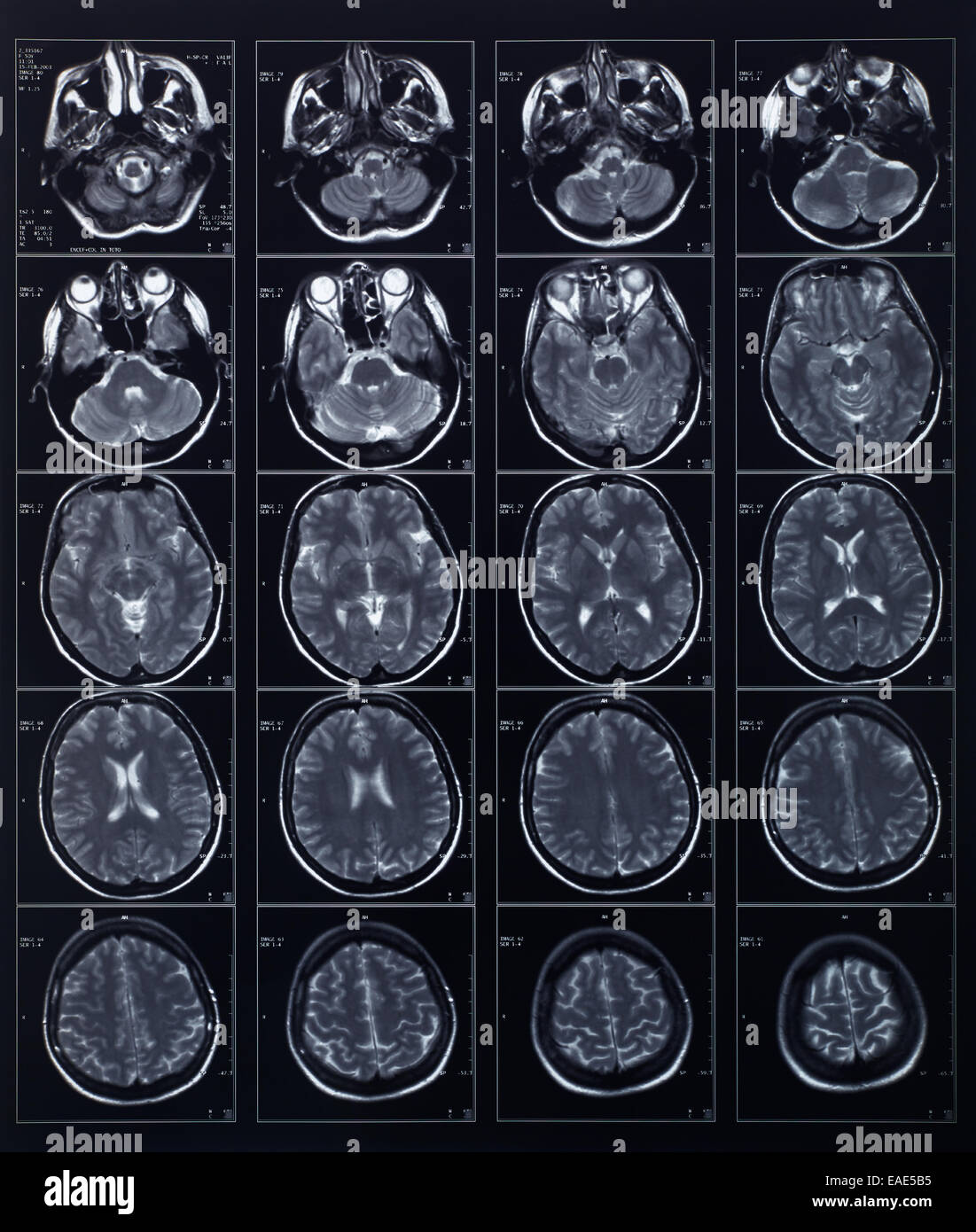 Testata a raggi X e la radiografia del cervello Foto Stock