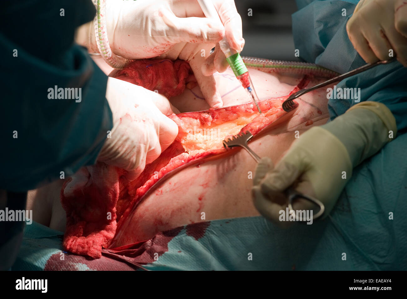 Un chirurgo team lavorano insieme su di un paziente durante un oparation in un ospedale Foto Stock