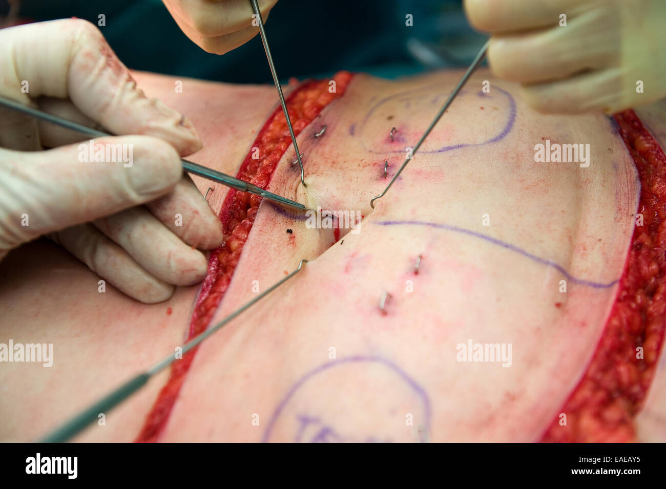 Un chirurgo facendo una incisione in prossimità del pulsante di emergenza durante un'operazione Foto Stock