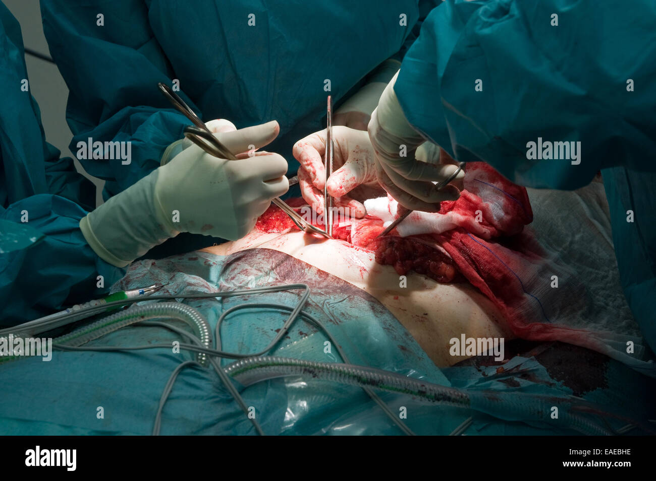 Un chirurgo team lavorano insieme su di un paziente durante un'operazione in un ospedale Foto Stock