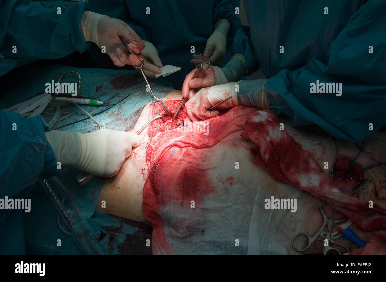 Un chirurgo team lavorano insieme su di un paziente durante un'operazione in un ospedale Foto Stock